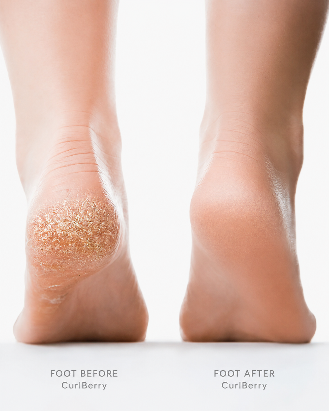 Foot Cellulite